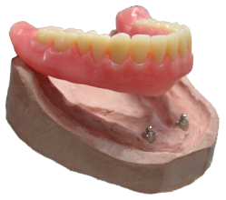la-prothese-complete-amovible-avec-implants
