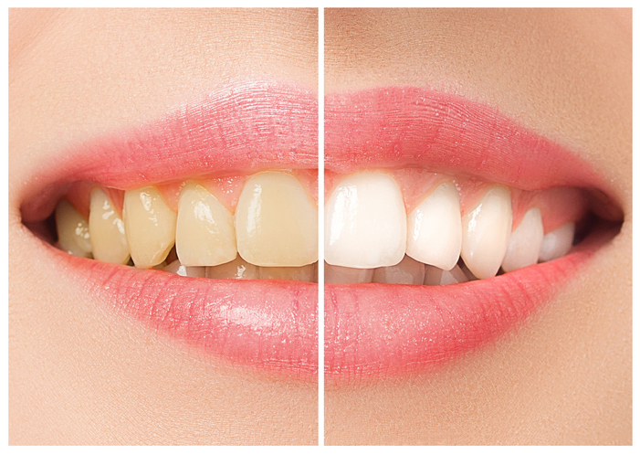 5 trucs pour garder ses dents blanches
