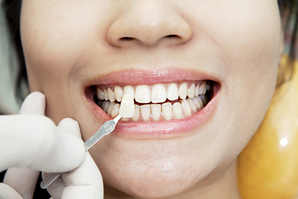 Des facettes dentaires pour un sourire radieux